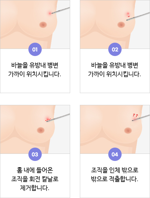 맘모톰이란?