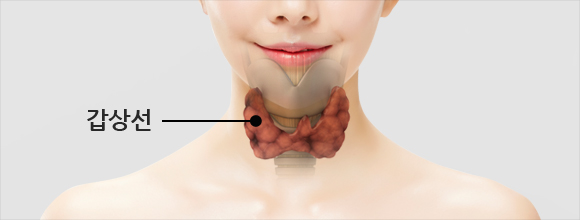 갑상선 양성 질환